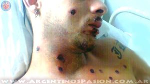 Argentinos Juniors: Martín Fredy Reimunder y las otras heridas en su rostro